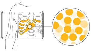 A graphic representing radioisotopes in the liver